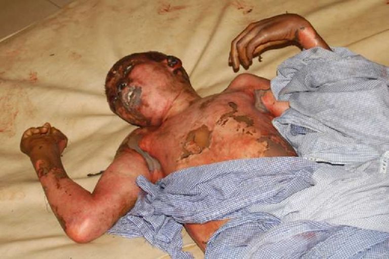 Woman Sets Two Sons Ablaze To Stop Husband
