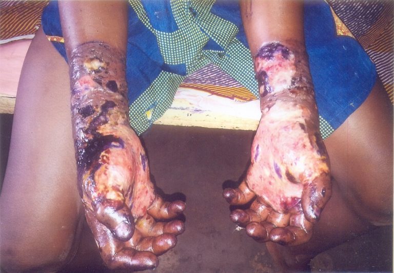 Cruel: Father Cuts Off 11 Year-Old Son’s Hands