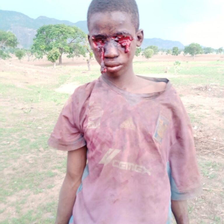 Two eyes of 16 year old boy removed in Bauchi
