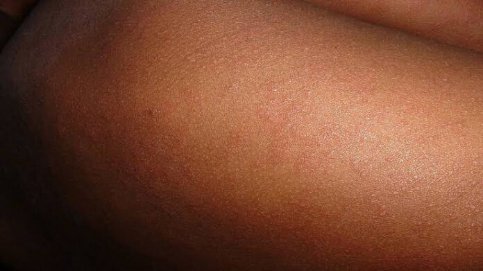 Children Die From Suspected Measles Outbreak In FCT Health facility