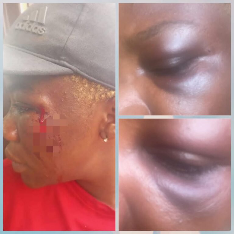 ‘He Ate My Food and Blinded Me’ — Nnewi Single Mum Cries for Justice After Attack by Debtor
