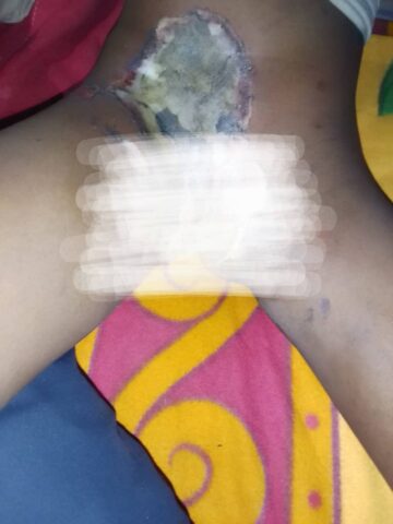 Housewife burnt the private part of 10 year old girl with hot metal object over alleged witchcraft