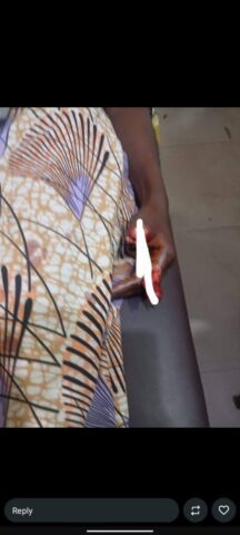 Suspected phone snatcher attack woman, cut off 2 fingers, ear